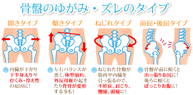 骨盤の歪み、ずれのタイプのイラスト